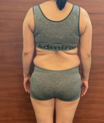 バック ビフォー写真 女性