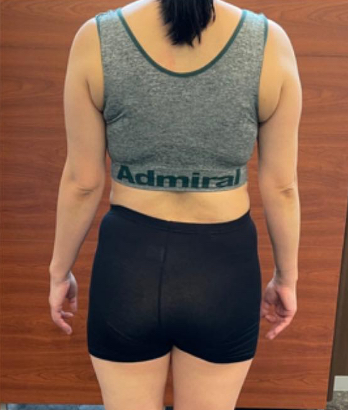 バック アフター写真 女性