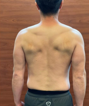 バック アフター写真 男性